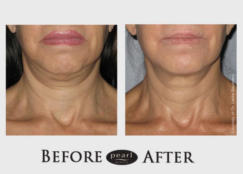 Non-Surgical Skin Tightening Market 