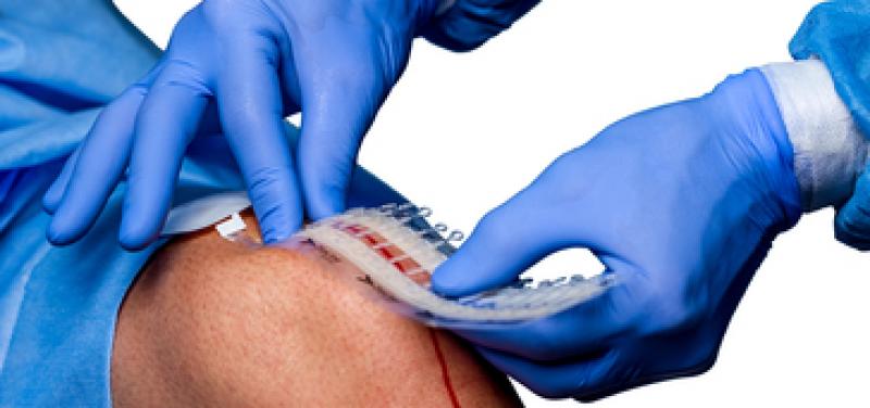 Noninvasive Surgical Wound Closure Market