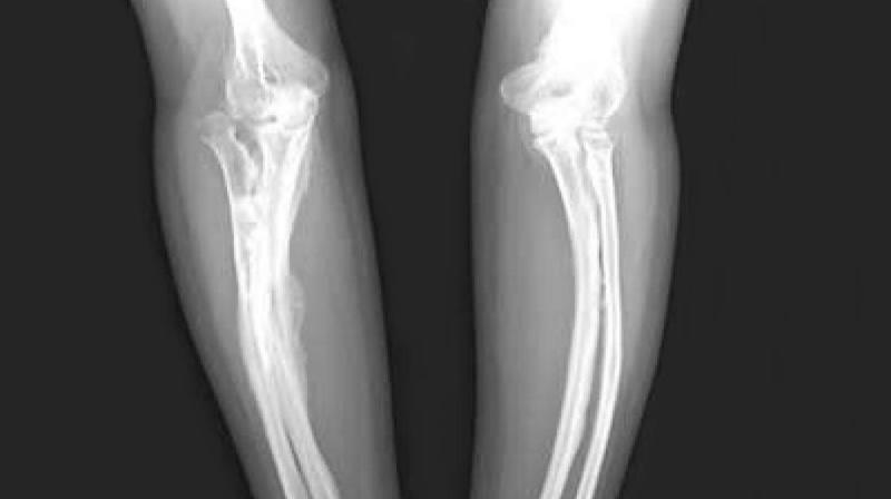 OSTEOGENESIS IMPERFECTA TREATMENT MARKET