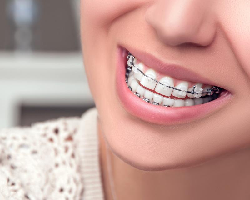 Orthodontic Supplies