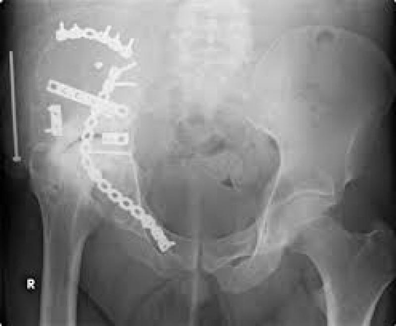 Orthopaedic Oncology Market