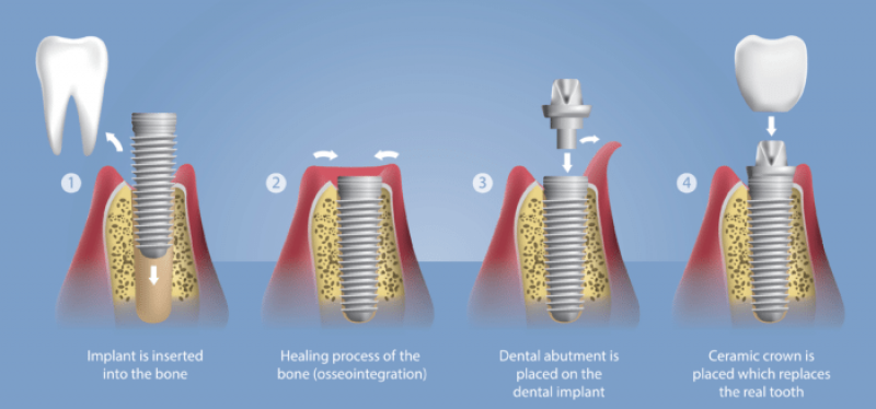 Osseointegration Implants Market