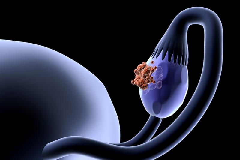Ovarian Cancer Treatment Doctors Mumbai