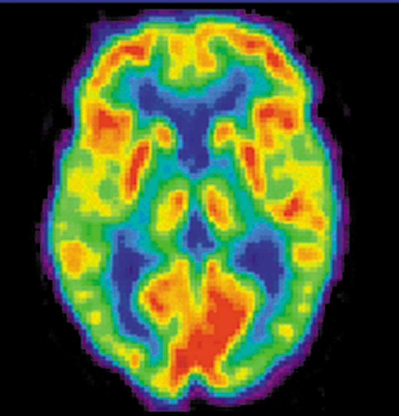 United States PET-CT Scanners Market Report 2017 PET-CT Scanners