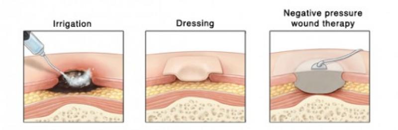 Pressure Ulcer Treatment Market 