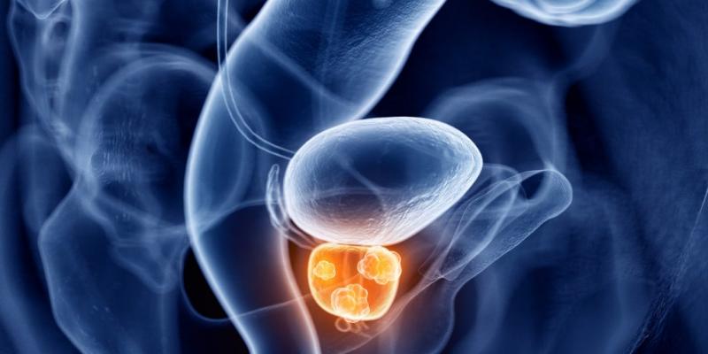  Prostate Cancer