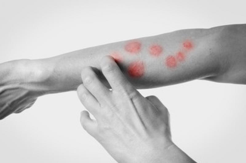 Pruritus Therapeutics Market