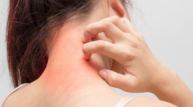 Pruritus Therapeutics Market