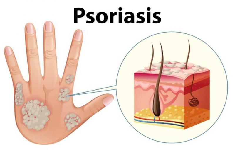 Psoriasis Drugs Market Size 