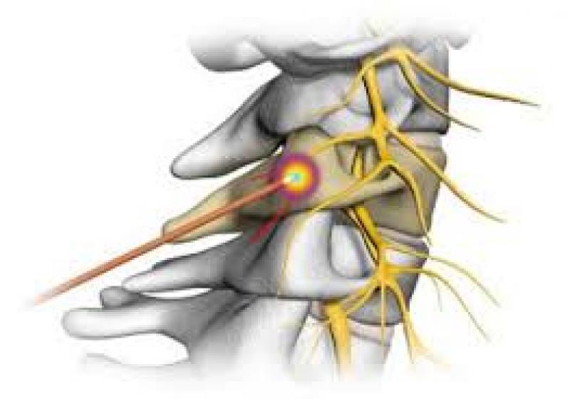 Radiofrequency Ablation Market