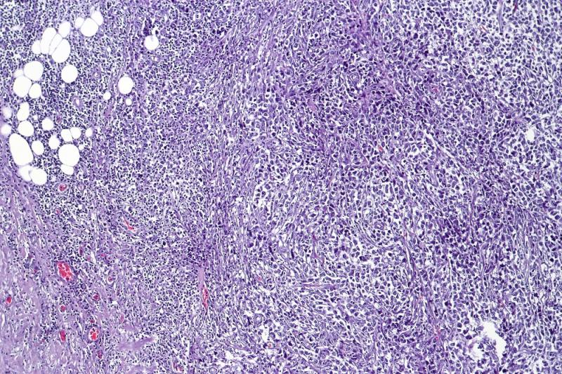 Relapsed Or Refractory Diffuse Large B Cell Lymphoma Market