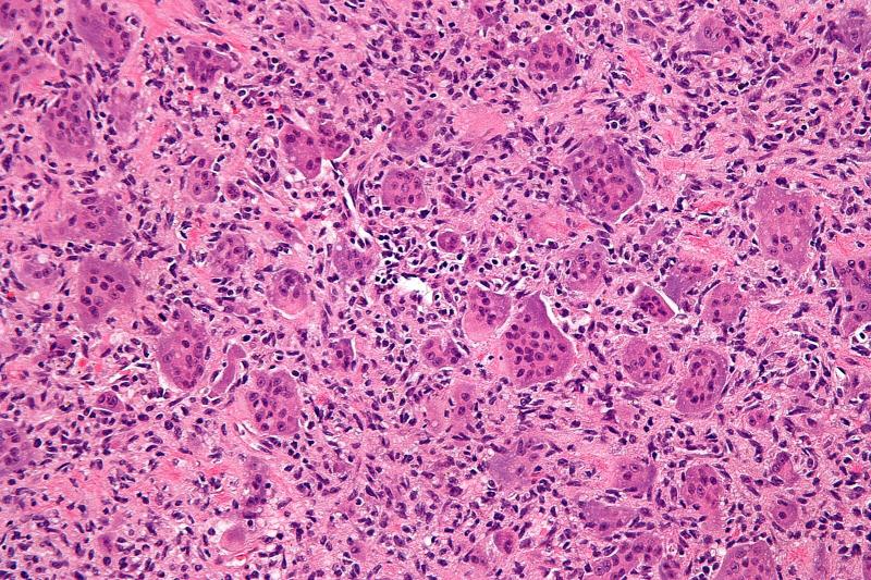 Relapsed or Refractory Diffuse Large B-cell Lymphoma
