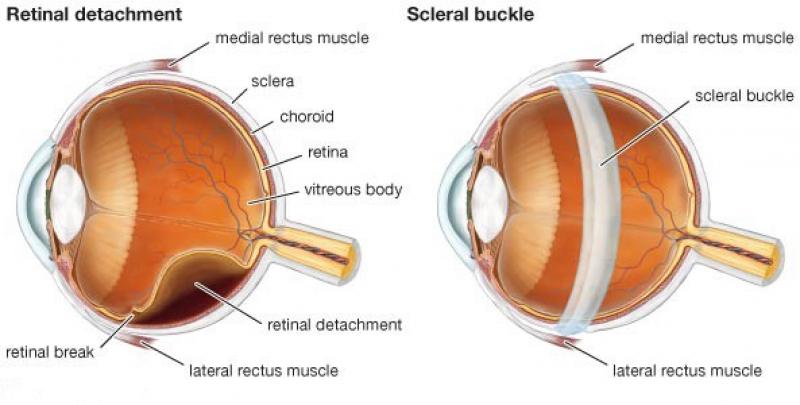 Retinal Detachment treatment Market