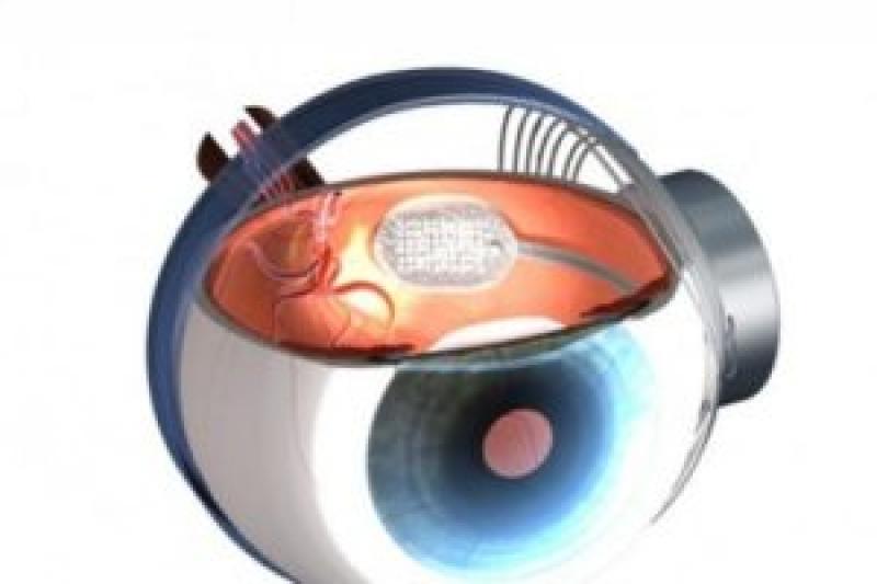 Retinal Implant Market