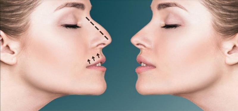 Rhinoplasty Market