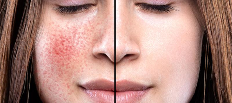 Rosacea Treatment Market