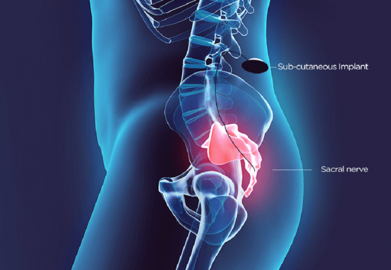 Sacral Nerve Stimulators Sales