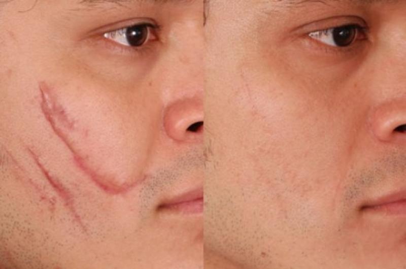 Scar Removal Treatment Sales Market