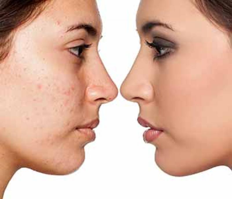 Scar Removal Treatment Market