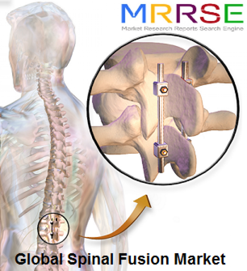 MRRSE
