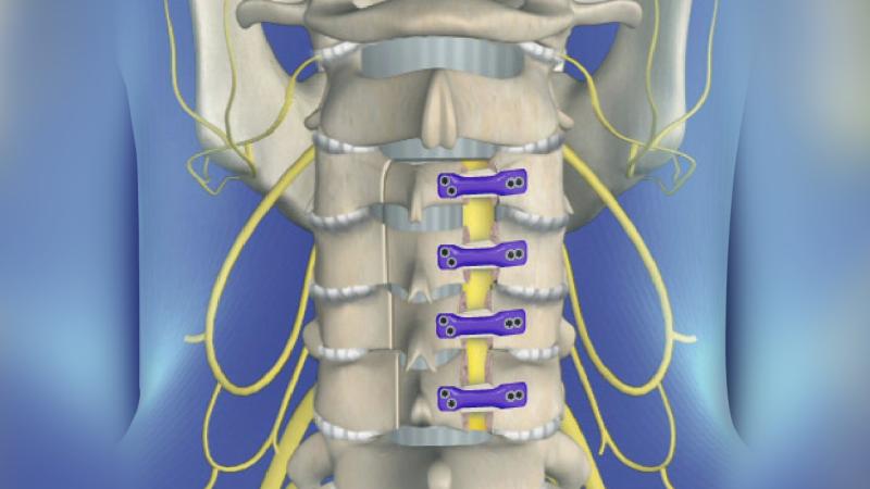  Spinal Laminoplasty Market 