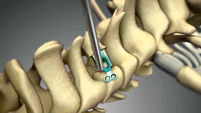Global Spinal Laminoplast