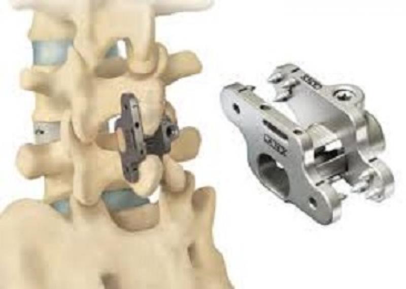 spinal fusion devices market
