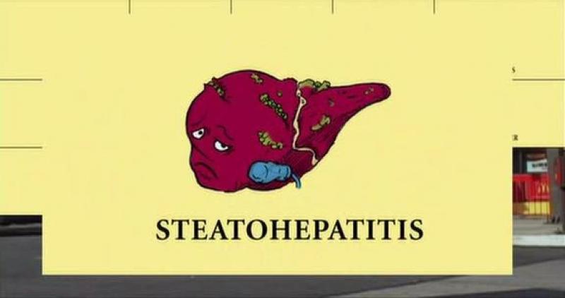 Steatohepatitis Clinical Trials Review 2015