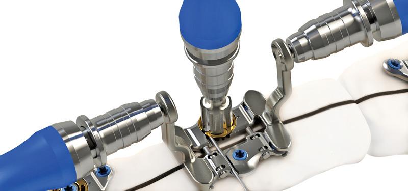 Sternal Closure Systems Market
