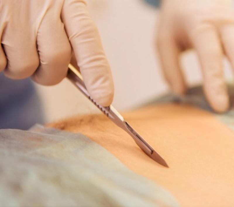 Surgical Blades and Scalpels Industry