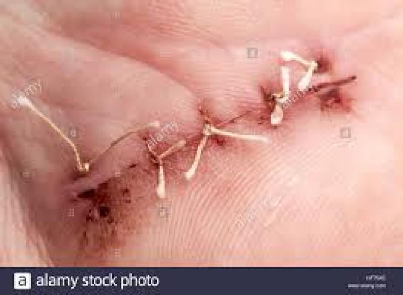 Surgical Sutures Market