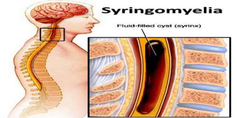 Syringomyelia Market 
