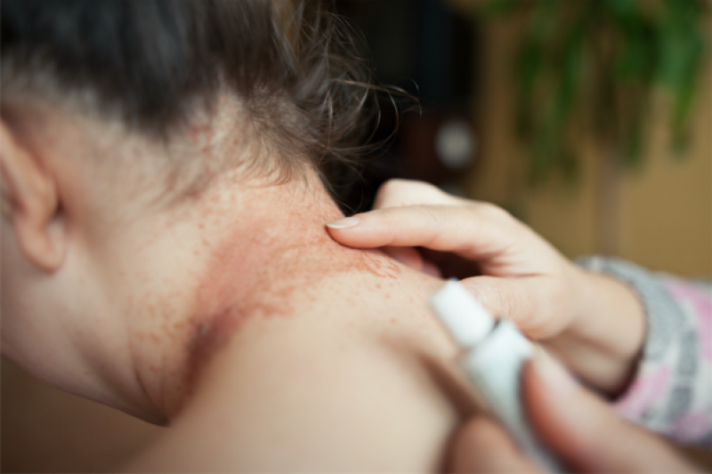 Topical Corticosteroids Market