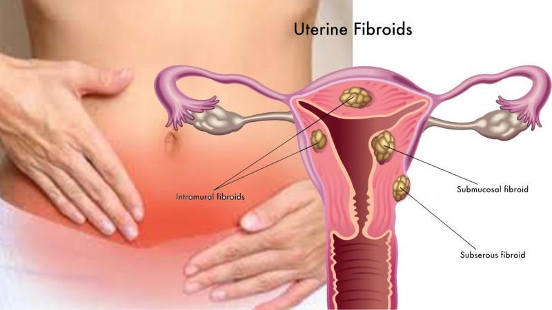 Uterine Fibroid Market