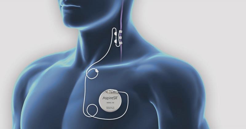 Vagal Nerve Stimulation (VNS) Market 