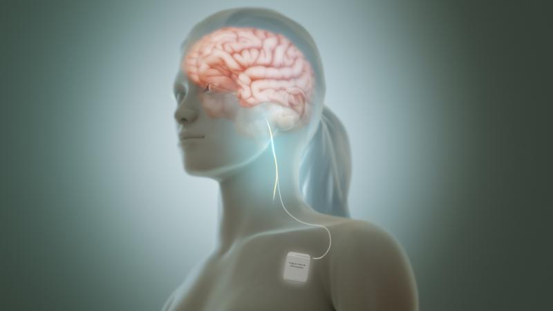 Vagus Nerve Stimulators