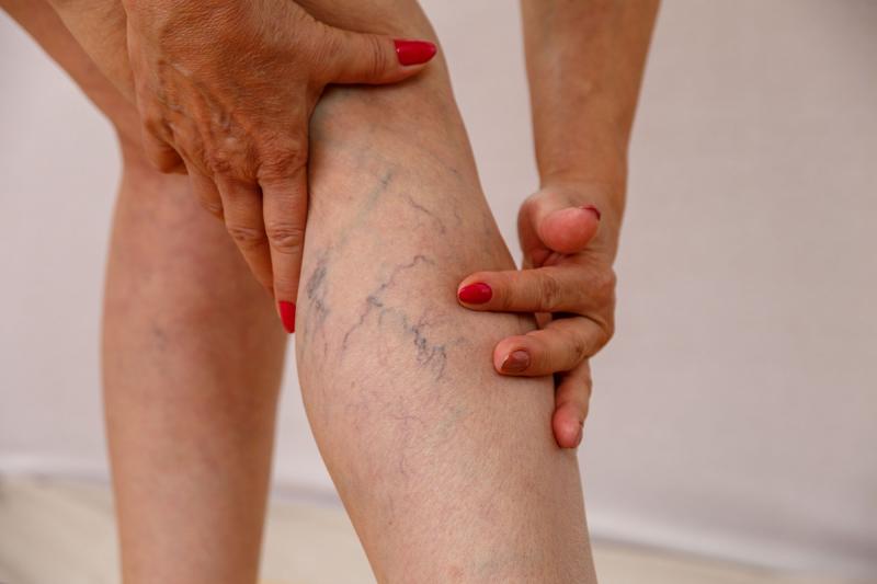Varicose Vein Treatment Devices Market