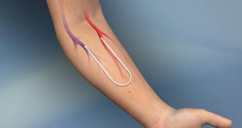 Vascular Graft Market