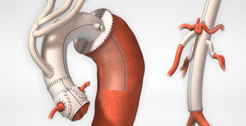 Global Vascular Patches Market 