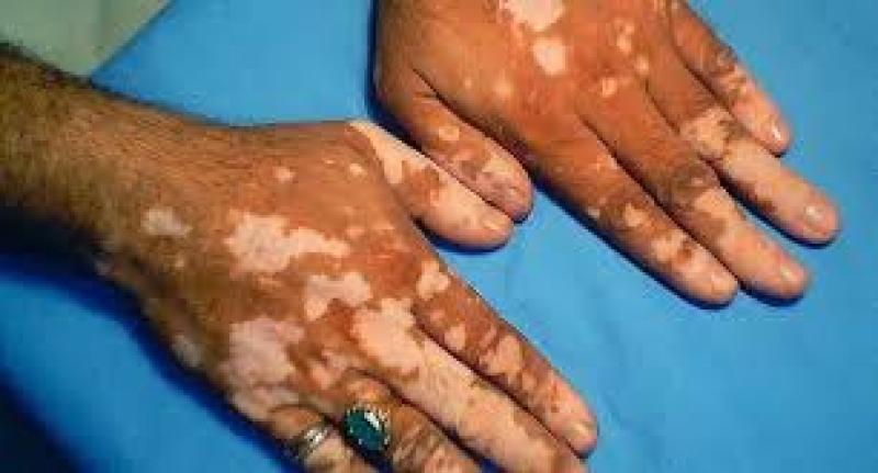 Vitiligo Drug