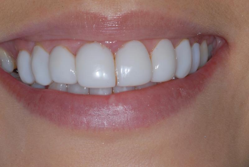 Getting Porcelain Veneers