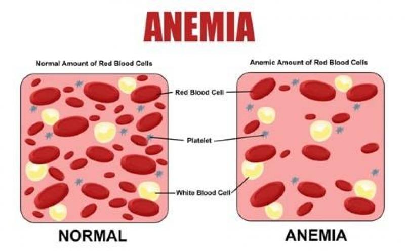 Anemia Test Anemia Test