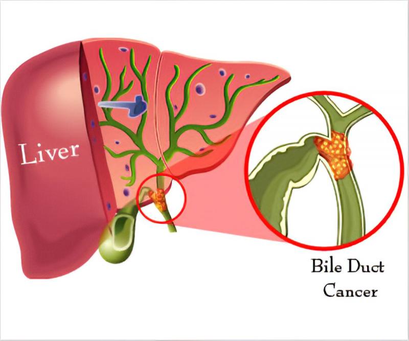 Bile Duct Cancer Market 
