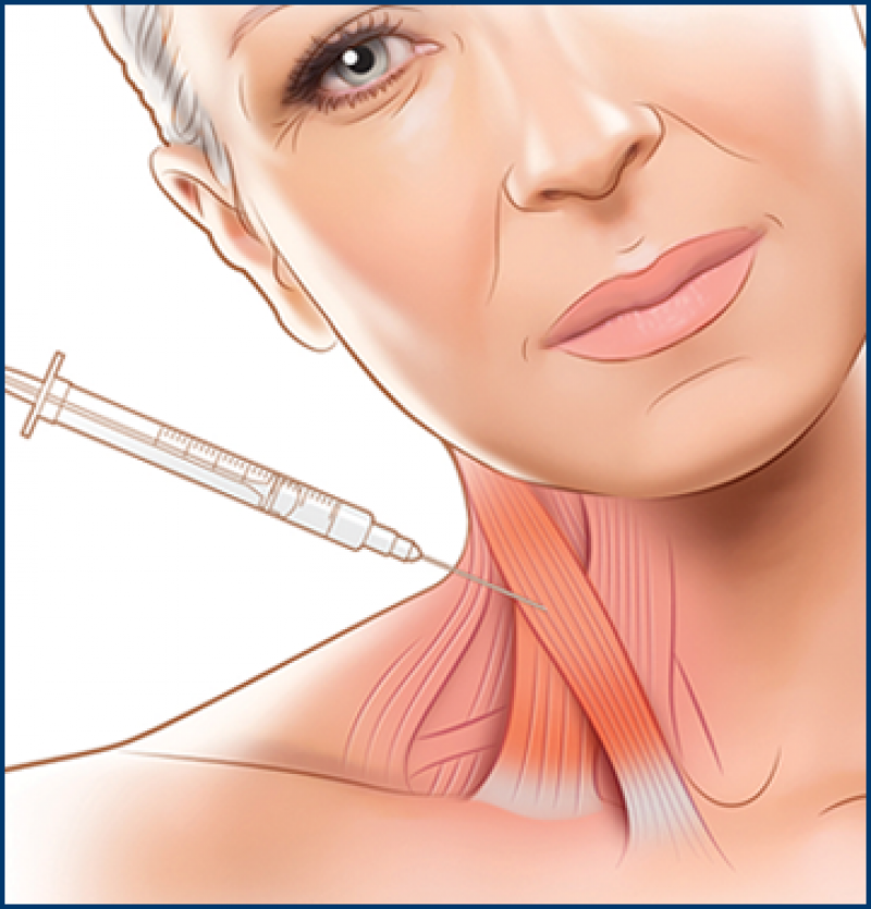 cervical dystonia management market