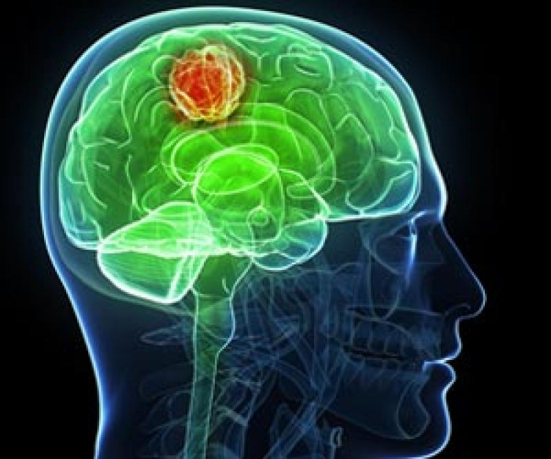 Glioblastoma Multiforme Treatment Market