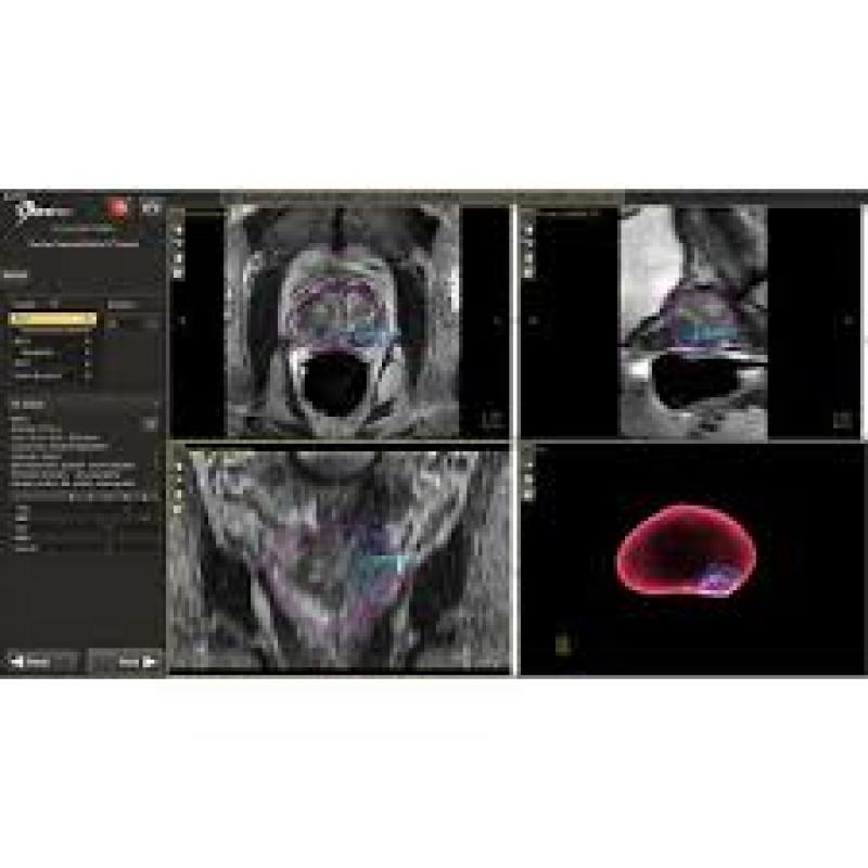 Global Prostate Cancer Diagnostics Market