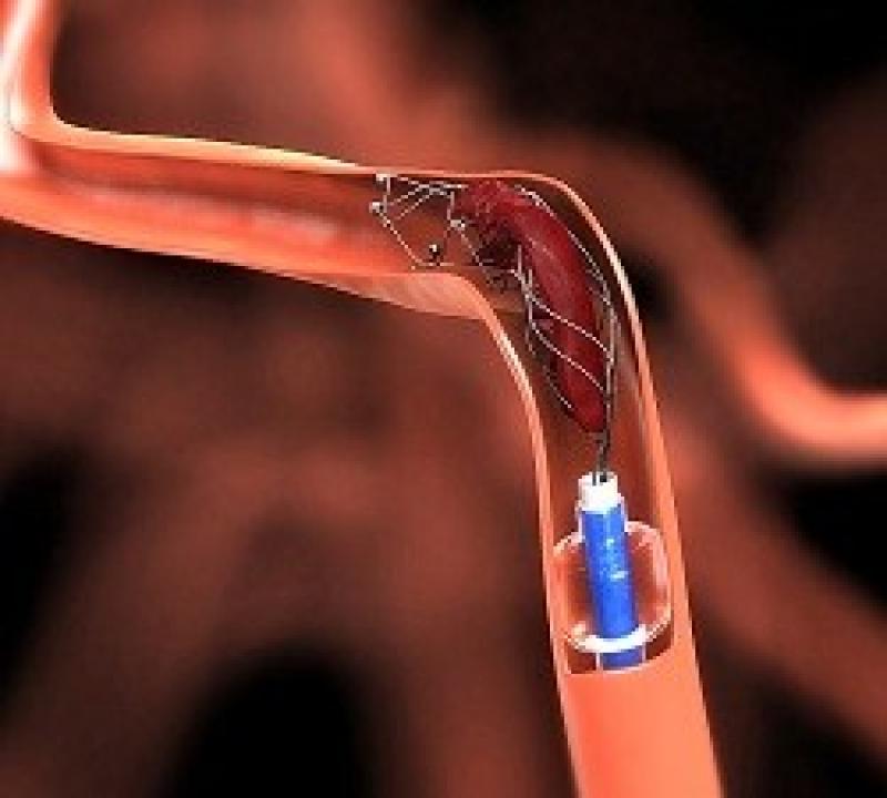 Global Thrombectomy Devices Market