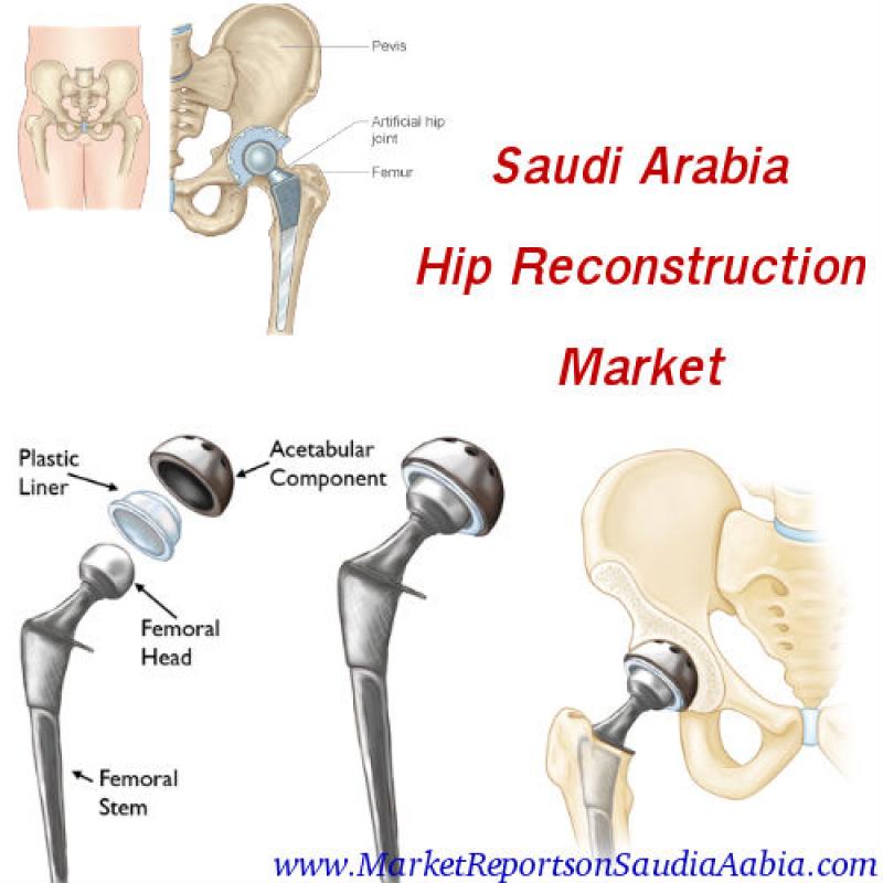 Hip Reconstruction