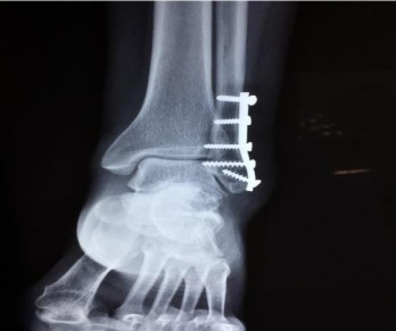 Joint Reconstruction Devices And Equipment Market