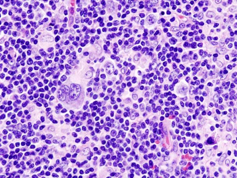 T-cell Lymphoma Market